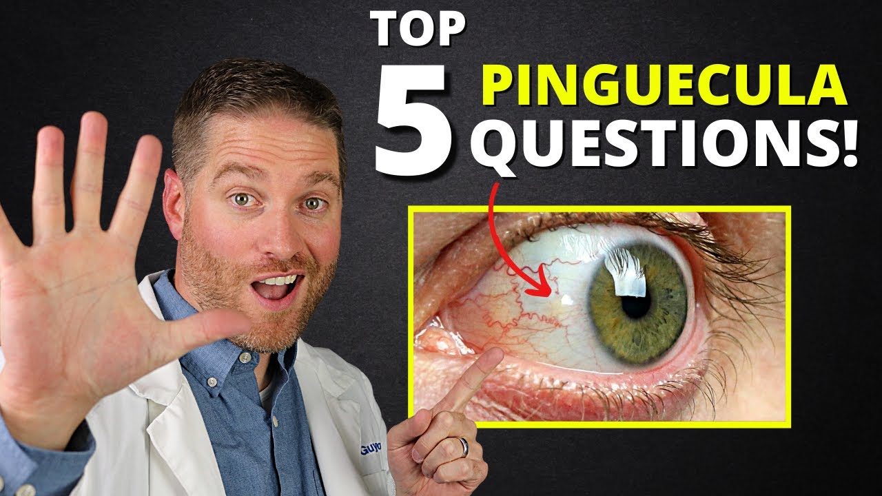 Yellow Spot On Your Eye (Pinguecula) - Top 5 Questions Answered! Yellow Spot On Your Eye (Pinguecula) - Top 5 Questions Answered!