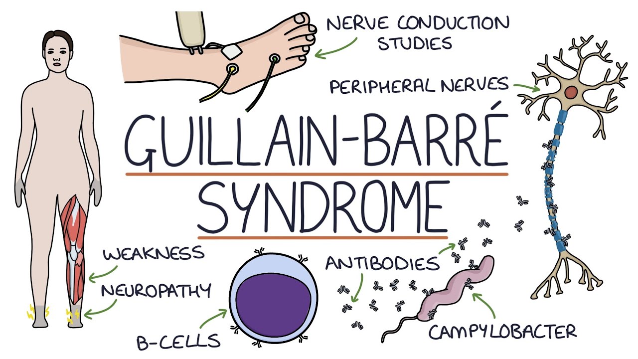 Understanding Guillain-Barré Syndrome Understanding Guillain-Barré Syndrome